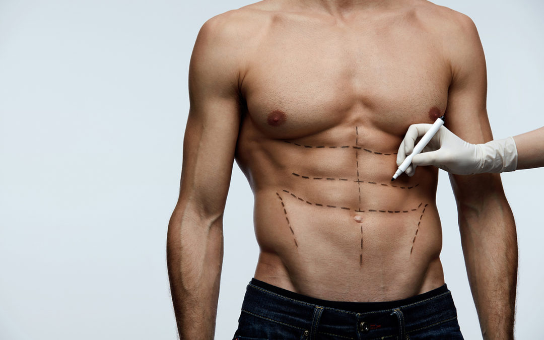 Comment obtenir de beaux abdominaux ? Découvrez l’abdominal etching