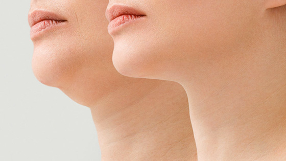 En finir avec son double menton grâce à la lipoaspiration