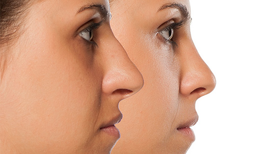 Résultat définitif rhinoplastie : quand voit-on le résultat final ?